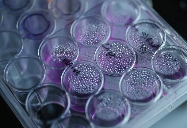 Una bandeja que contiene células cancerosas se encuentra en un microscopio óptico en el Laboratorio de Nanomedicina de la Facultad de Farmacia de la UCL en Londres el 2 de mayo de 2013. (Crédito de la foto: REUTERS/SUZANNE PLUNKETT)
