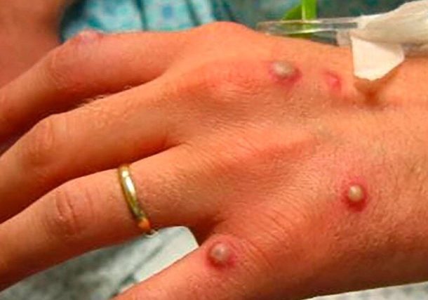 Varios países reportan casos de la viruela del mono