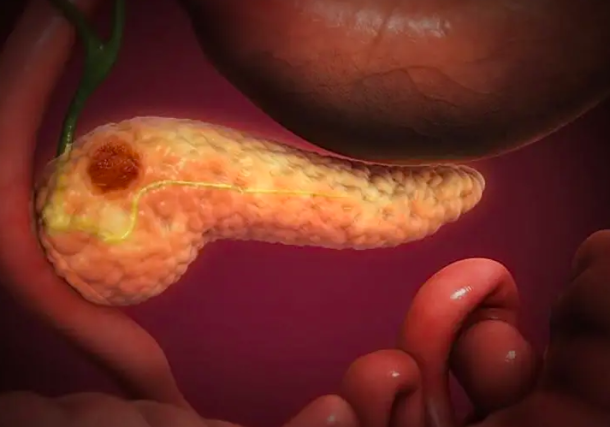 Radio Jai -Científicos israelíes descubren cómo el cáncer de páncreas se propaga y mata: estudio