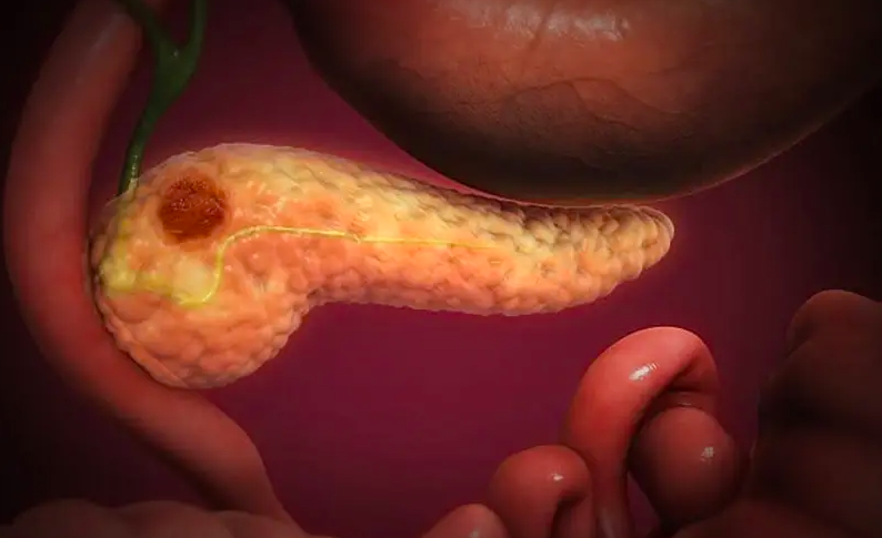 Radio Jai -Científicos israelíes descubren cómo el cáncer de páncreas se propaga y mata: estudio