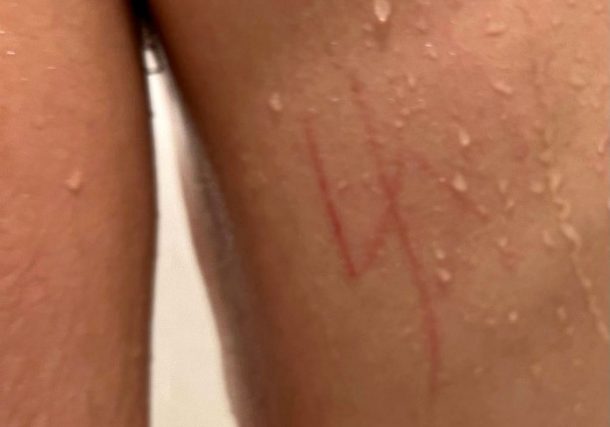 Radio Jai -Esvástica tallada en la espalda de un adolescente judío con necesidades especiales cerca de Las Vegas