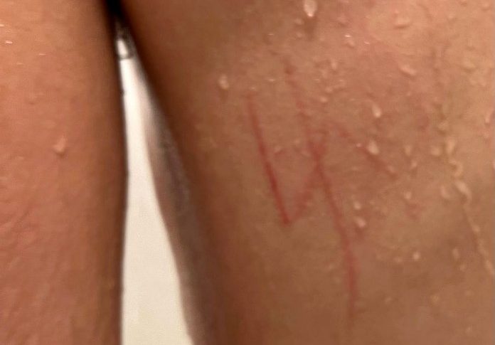 Radio Jai -Esvástica tallada en la espalda de un adolescente judío con necesidades especiales cerca de Las Vegas