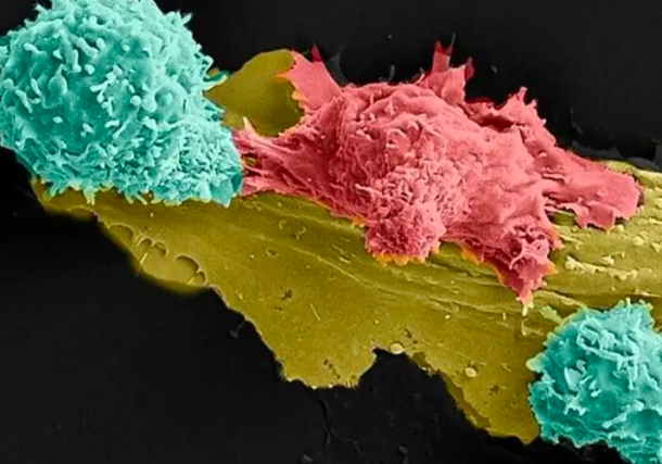 Radio Jai -Innovador tratamiento contra el cáncer israelí tiene una tasa de éxito del 90 %