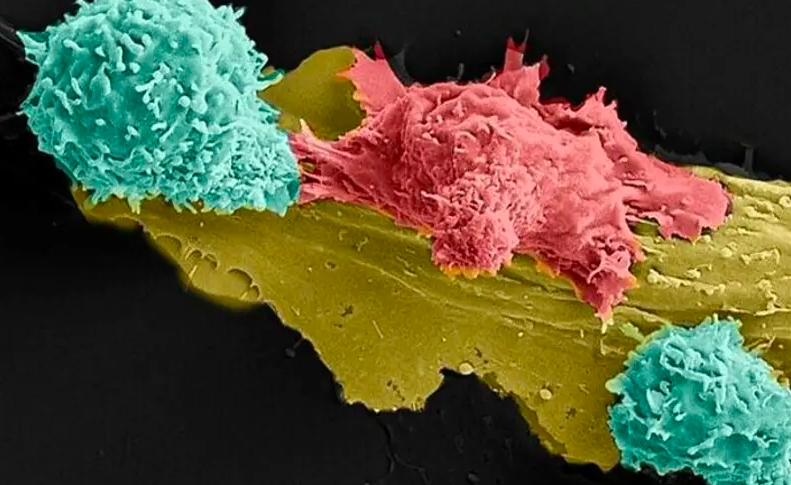 Radio Jai -Innovador tratamiento contra el cáncer israelí tiene una tasa de éxito del 90 %