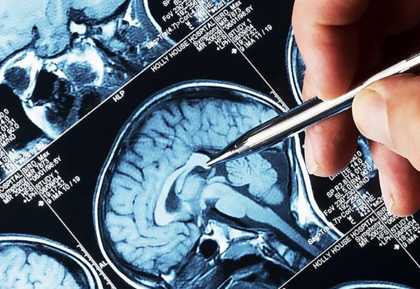 Radio Jai-Informe científico revela que el 40% del mundo sufre afecciones neurológicas